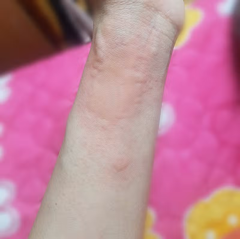 너무 가려운 콜린성 두드러기 해결방법 없을까요?