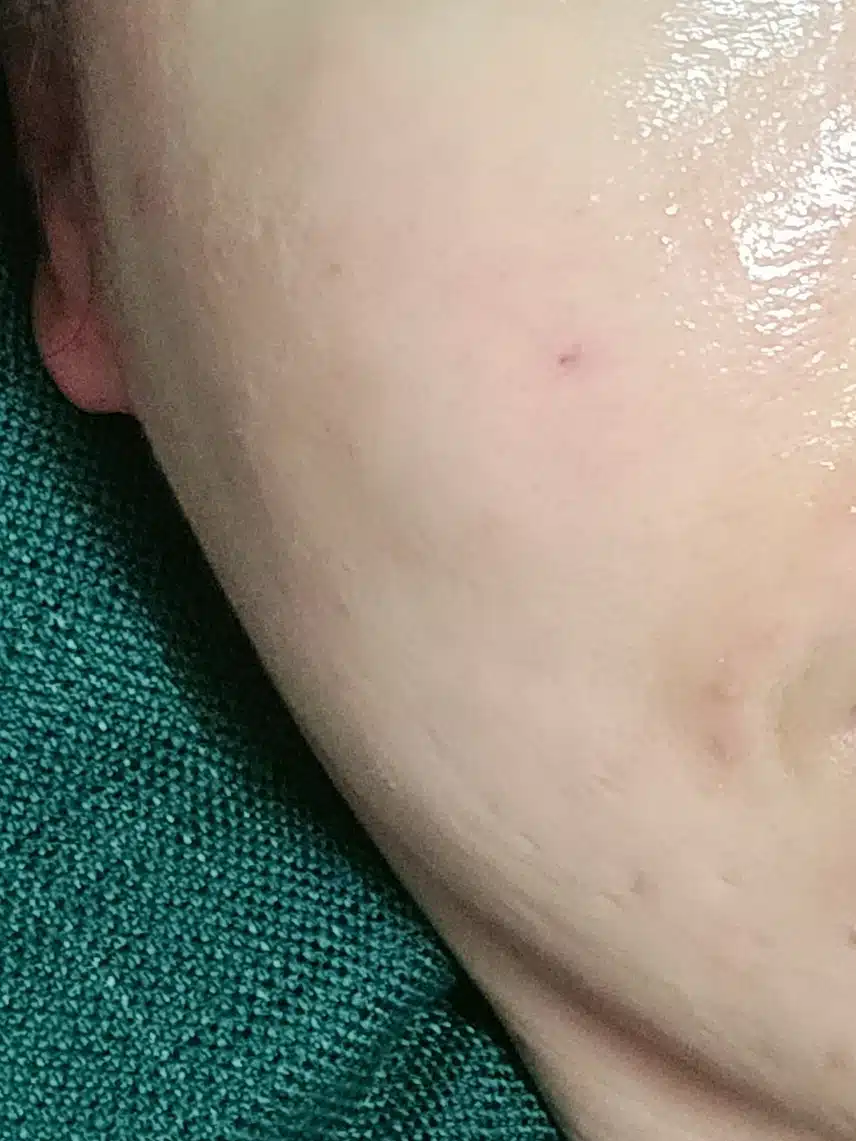 물광주사 효과와 시술에 대한 경험 공유