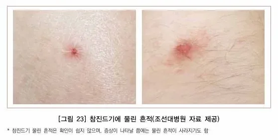 진드기 물린자국, 이불·침대·집진드기 때문일까? 증상과 치료법