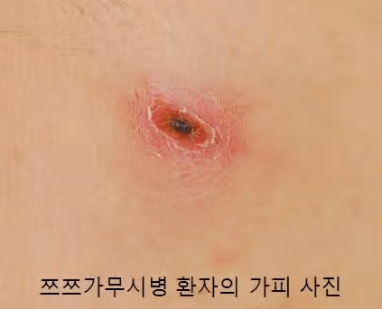 진드기 물린자국, 이불·침대·집진드기 때문일까? 증상과 치료법