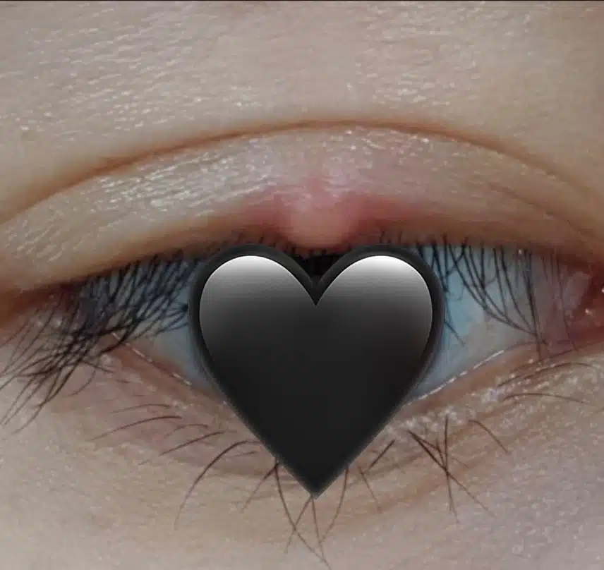 결막염+다래끼 염증 콤보였던 다래끼 치료 후기
