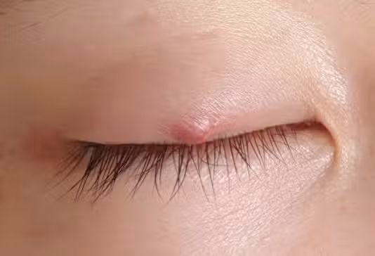 결막염+다래끼 염증 콤보였던 다래끼 치료 후기