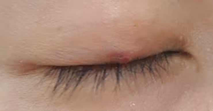 결막염+다래끼 염증 콤보였던 다래끼 치료 후기