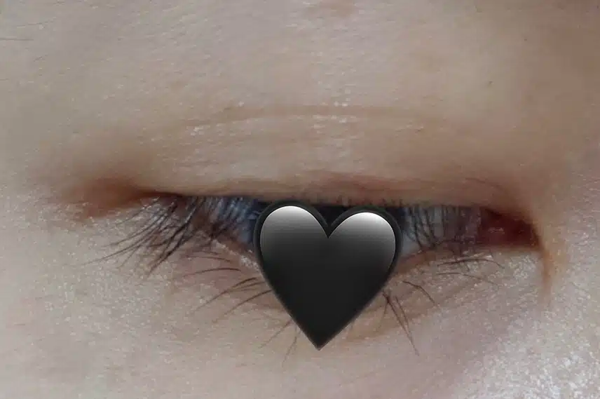 결막염+다래끼 염증 콤보였던 다래끼 치료 후기