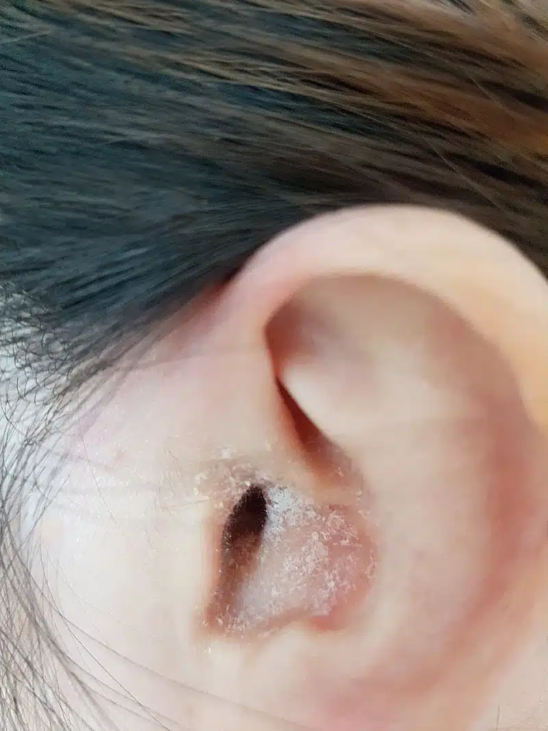 귀 파는 습관이 부른 외이도염 원인과 극복기