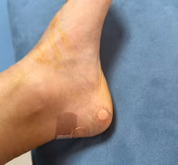 딱딱한 신발 때문에 생긴 아킬레스건염 치료 후기