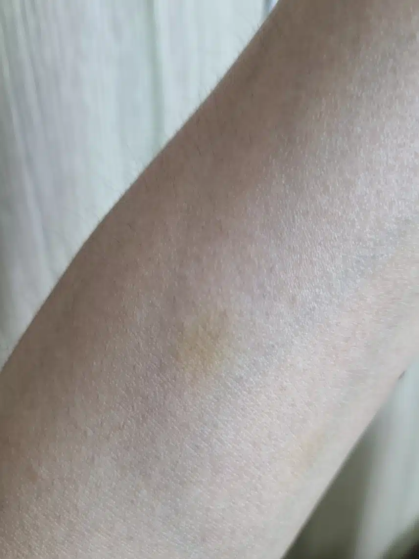 몸에 노랗게 멍이 나는 이유가 뭘까요?