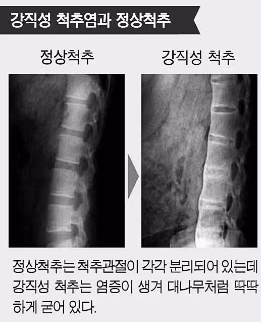 강직성 척추염 원인은 무엇일까요?