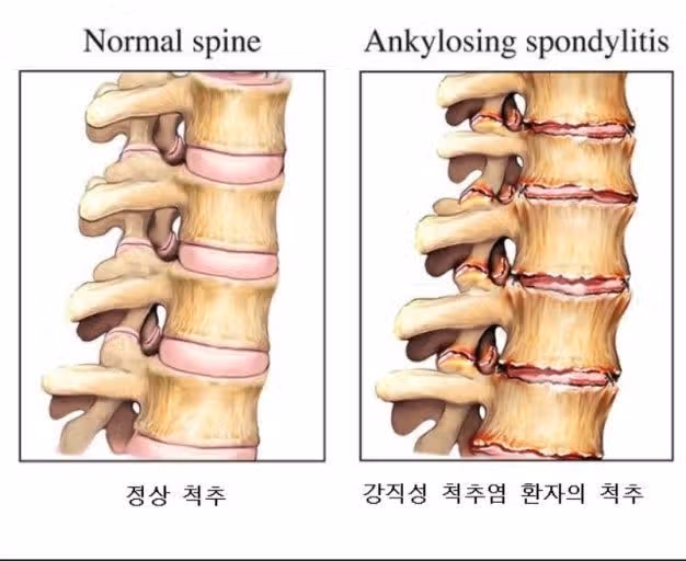 강직성 척추염 원인은 무엇일까요?