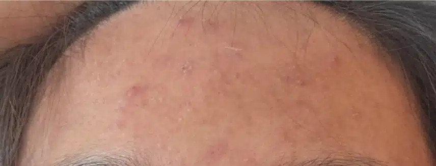 청소년기 아들 여드름 치료 압출 10회 패키지 후기!!