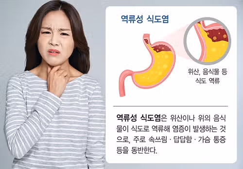 역류성 식도염 때문에 잠을 못 자요… 혹시 해결법 있으신가요?