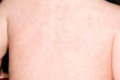홍역 예방접종 어디서 맞고, 비용은 얼마일까? 술 마셔도 괜찮을까?