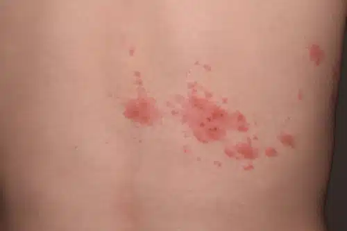 대상포진 병원 어디로? 초기증상 가려움·팔 통증 자가진단 후 이렇게 하세요