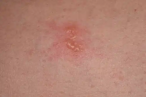 대상포진 병원 어디로? 초기증상 가려움·팔 통증 자가진단 후 이렇게 하세요