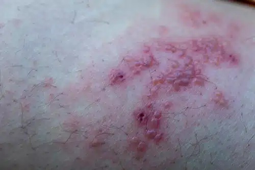 대상포진 병원 어디로? 초기증상 가려움·팔 통증 자가진단 후 이렇게 하세요