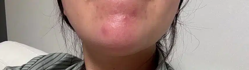 턱드름이 너무 자주 나는데 해결방법 있을까요?