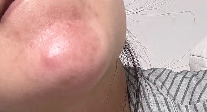 턱드름이 너무 자주 나는데 해결방법 있을까요?