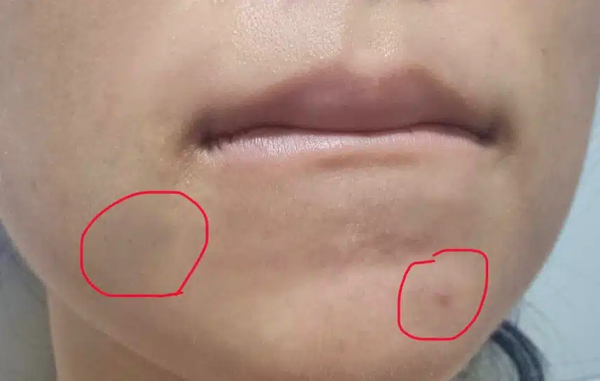 턱드름이 너무 자주 나는데 해결방법 있을까요?