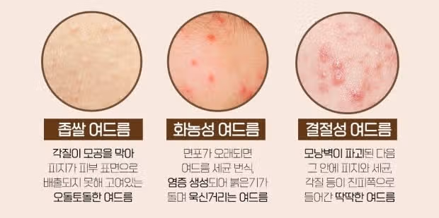턱드름이 너무 자주 나는데 해결방법 있을까요?