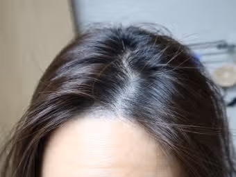 여름만 되면 두피에서 열폭발… 어떻게 관리하시나요?