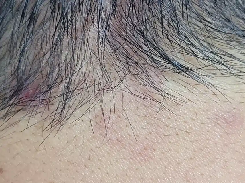 두피가 따가운데 여름 두피 케어 방법 좀 알려주세요~