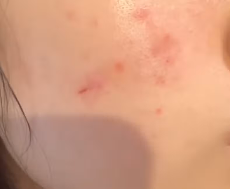 브링그린 징크테카 트러블세럼-여드름 진정과 흔적케어에 효과적 🔥 